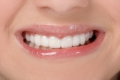 Snap-On Smile teeth after