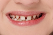 Snap-On Smile teeth before